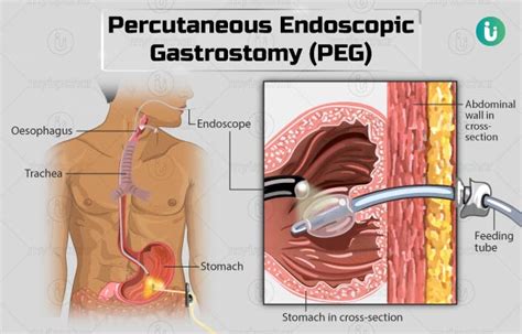 Percutaneous Endoscopic Gastrostomy