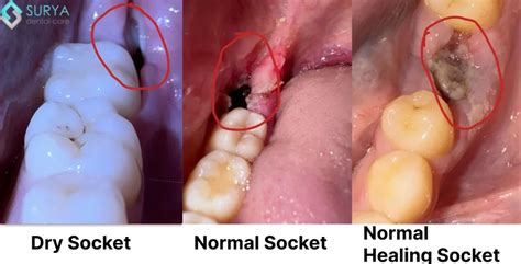 Pictures Dry Socket