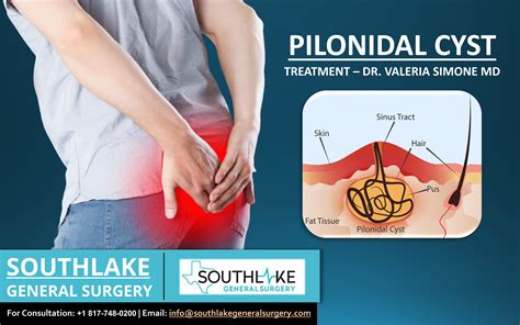 Pilonidal Cyst Treatment