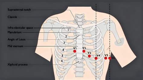 Placement Ecg