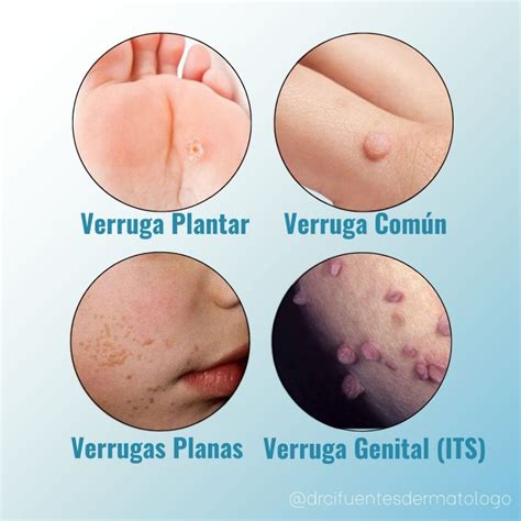 Porque Salen Las Verrugas