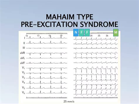 Pre Excitation Syndrome