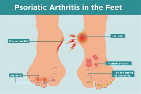 Psoriatic Arthritis Feet