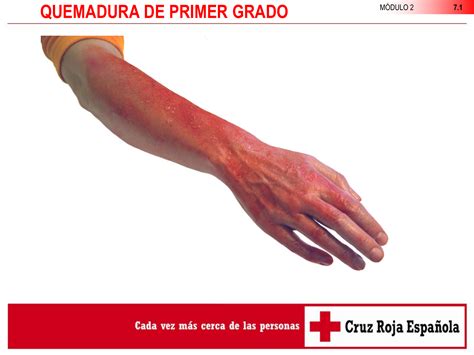 Quemaduras De Primer Grado