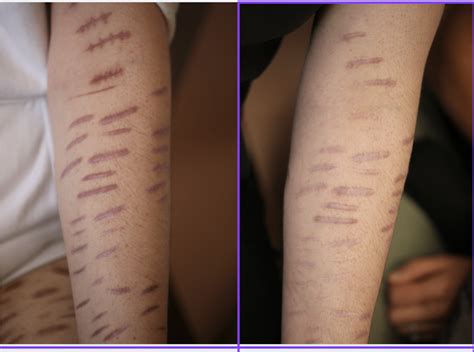 Self Harm Scars