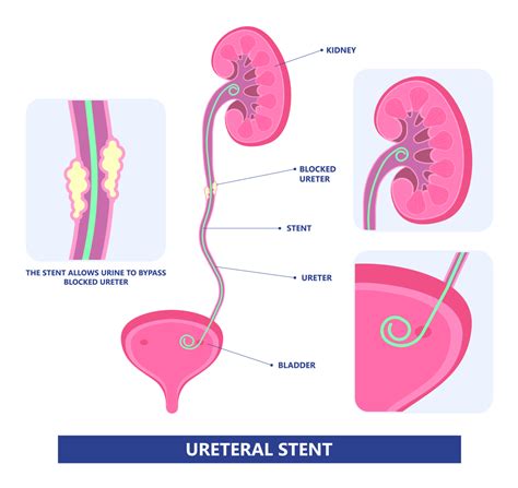 Signs Of Ureteral Stent Infection