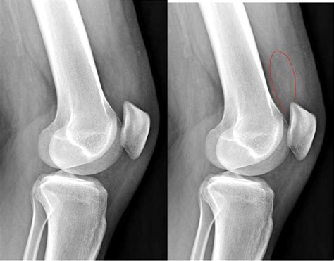 Small Knee Effusion
