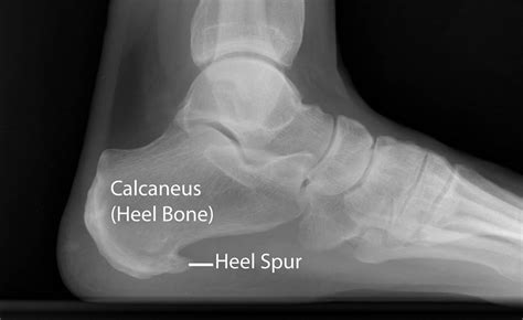 Spur On Heel Bone