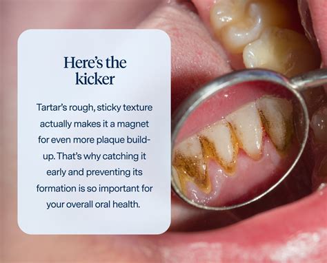 Tartar On Teeth