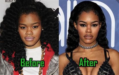 Teyana Taylor Before And After Face Surgery