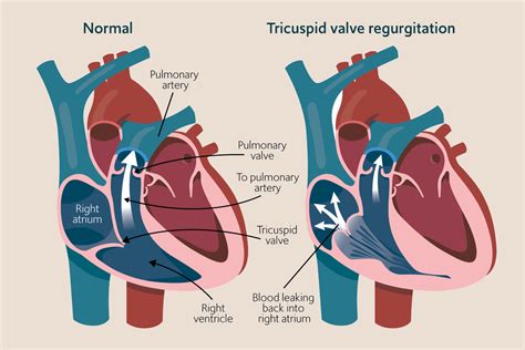 Trace Tricuspid Regurgitation