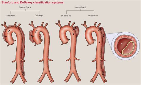 Type B Dissection