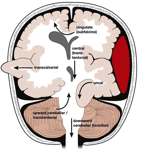 Uncal Herniation Brain