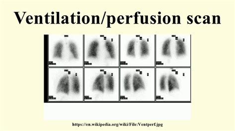 Ventilation Perfusion Scan