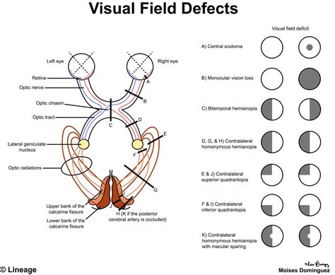 Visual Field Defects