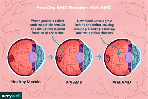 Wet Amd Vs Dry Amd