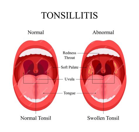 What Are Tonsils