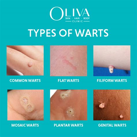 What Causes Warts