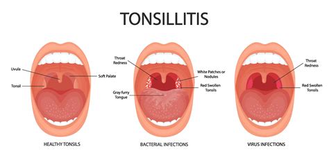 What The Tonsils Do