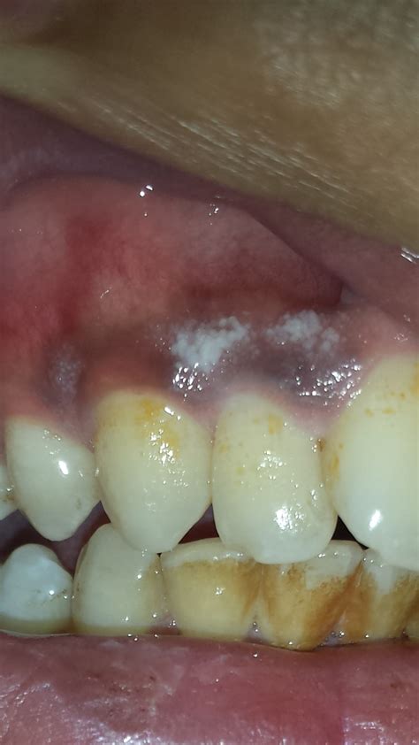 White Sores On The Gums