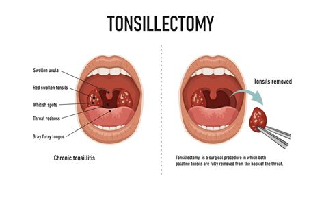 Why Should You Remove Tonsils